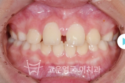 치료후기 이미지